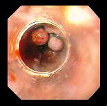 Esophageal varices