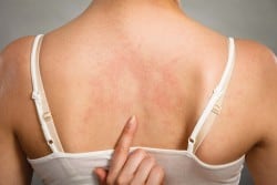 Could Your Rash Be a Symptom of Hepatitis C?