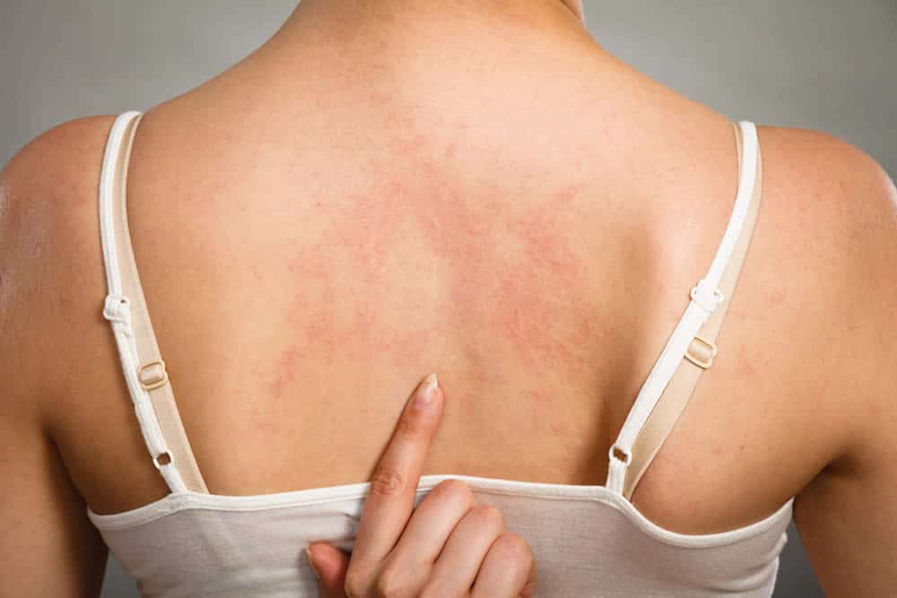 Hep C Symptoms - Could Your Rash Be One?
