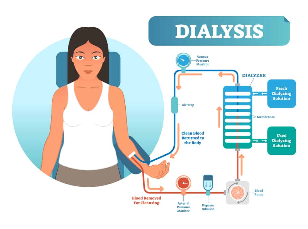What Is Liver Dialysis and Who Can Benefit From It?