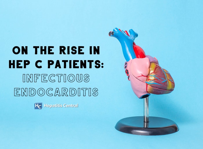 On the Rise in Hep C Patients: Infectious Endocarditis