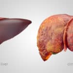 3 Methods to Predict Who Will Develop Liver Cancer After HCV Treatment