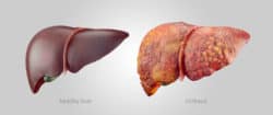 3 Methods to Predict Who Will Develop Liver Cancer After HCV Treatment