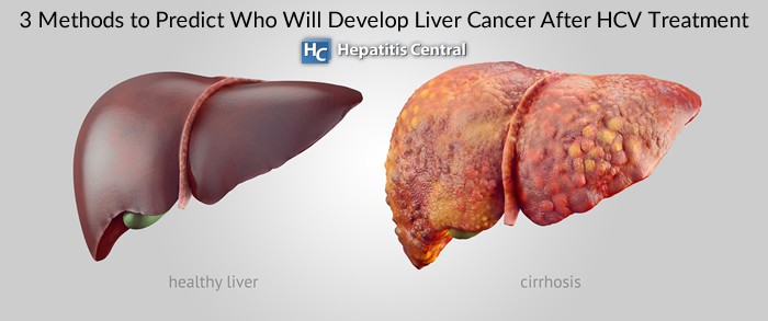 3 Methods to Predict Who Will Develop Liver Cancer After HCV Treatment