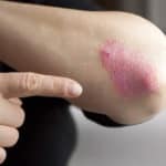 The Link Between Hepatitis C & Psoriasis