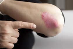 The Link Between Hepatitis C & Psoriasis