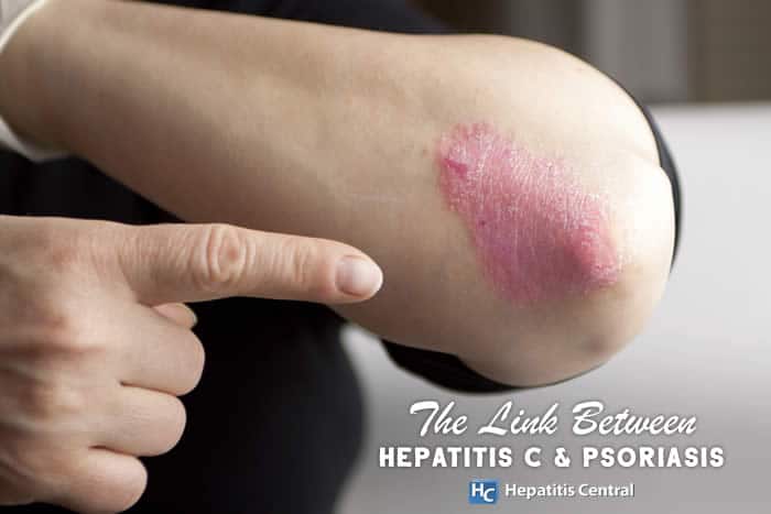 The Link Between Hepatitis C & Psoriasis
